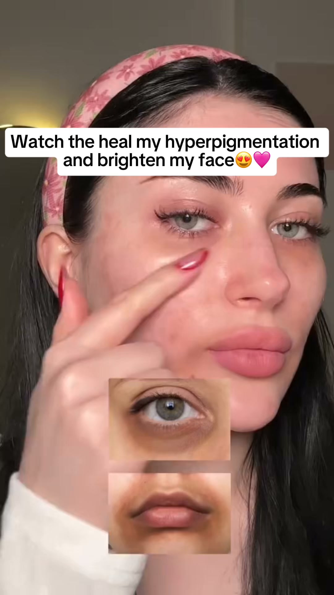 Antioxidant Care for Dark Spots + Post-Acne Marks