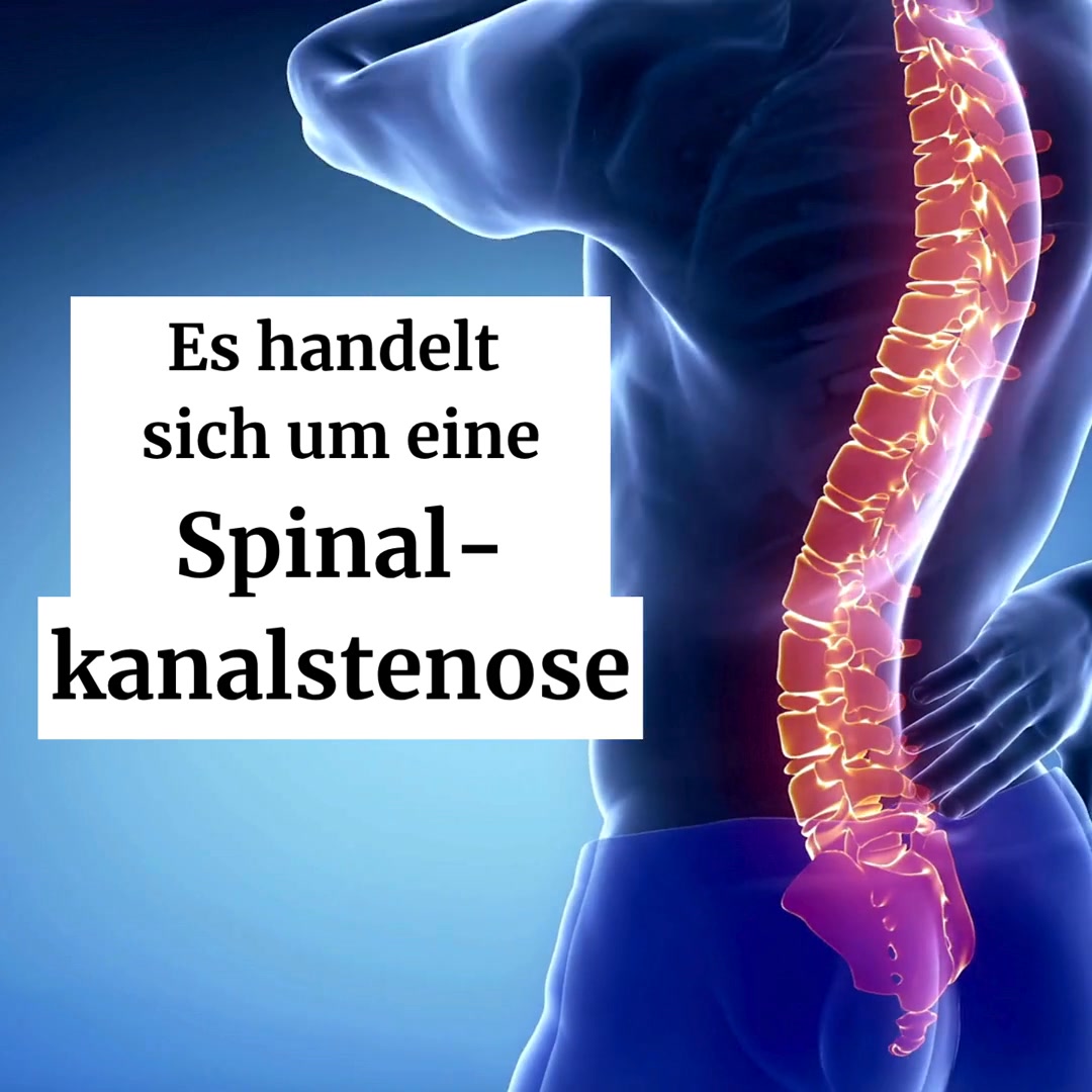 Spinalkanalstenose?
