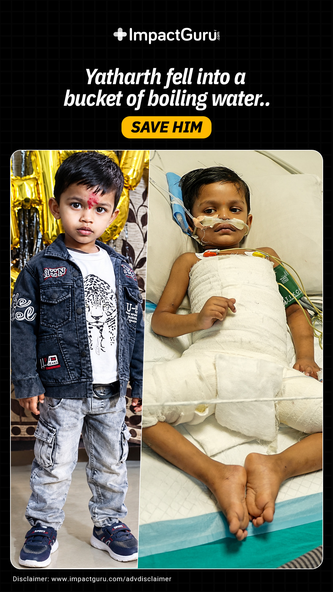 My 2 Y/O Was Burned After Falling Into Hot Water!