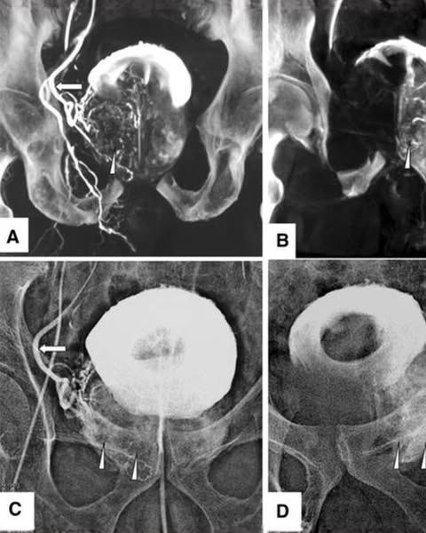 ED and Enlarged Prostate?