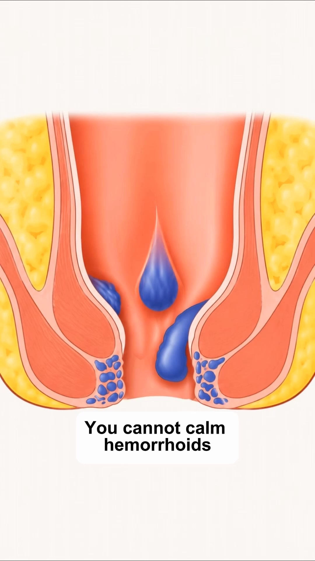 Fast Hemorrhoid Relief