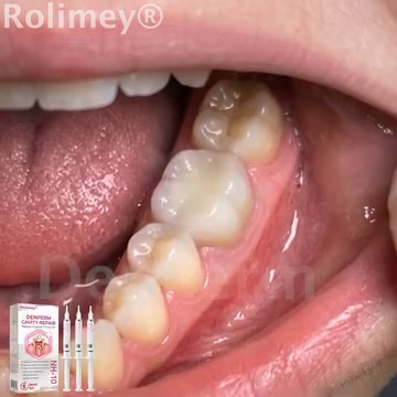 Cavity Repair FDA-Recognized 10% Nano-Hydroxyapatite (NH-10) | Delivery within 2-4 working days