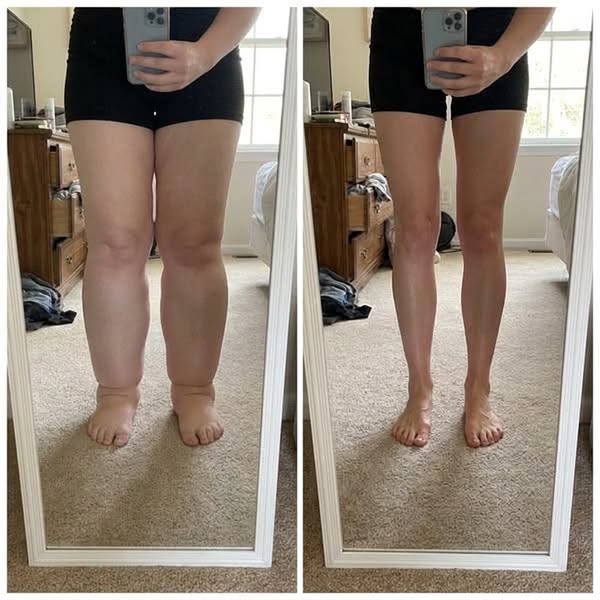 "4 years of my oedema swelling gone in 1 month?"
