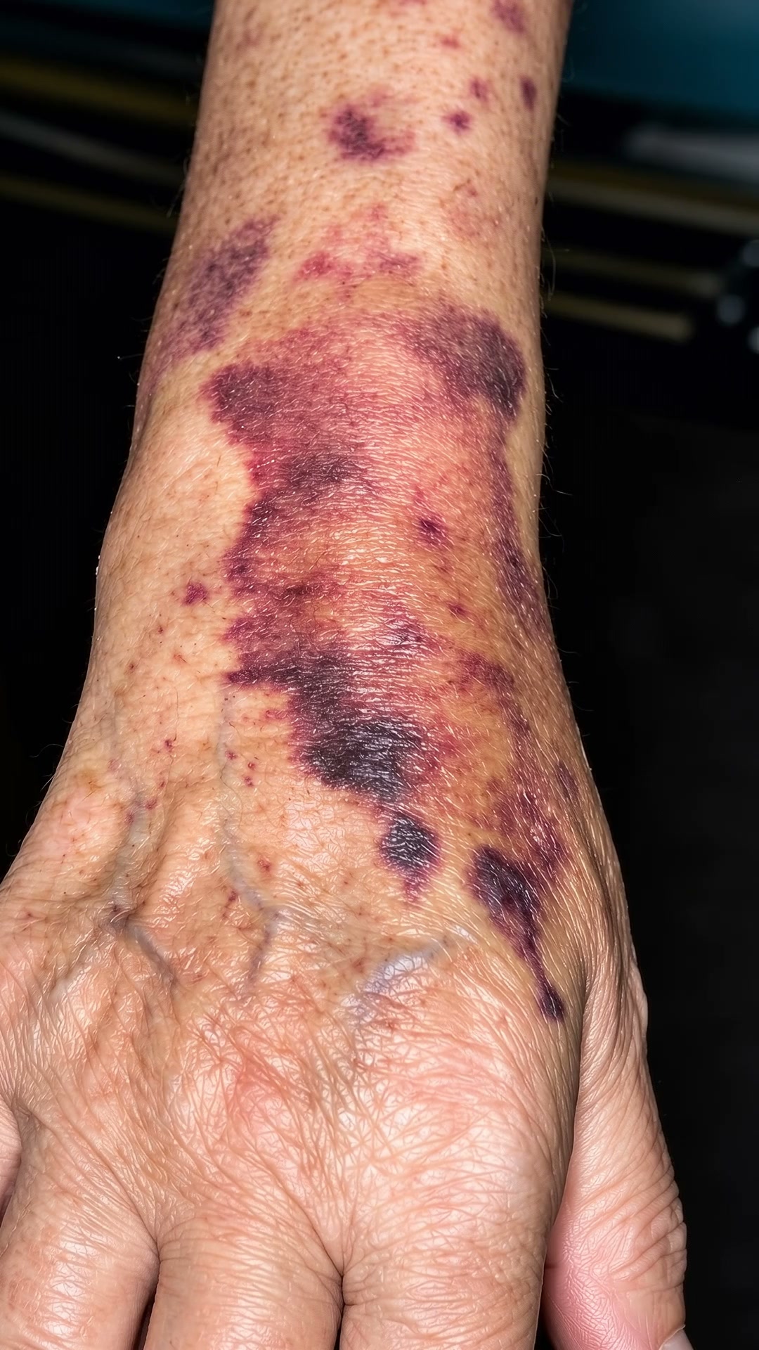 Senile Purpura Gone In Days