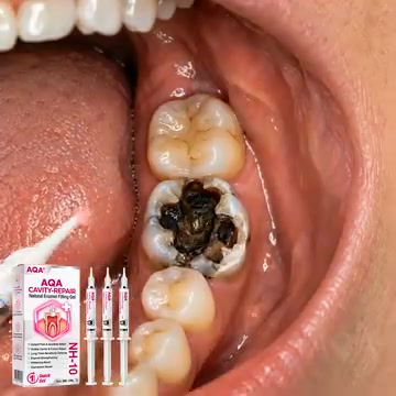 Cavity Repair | FDA-Recognized 10% Nano-Hydroxyapatite (NH-10) | Delivery Within 2–4 Business Days | Full Money-Back Guarantee