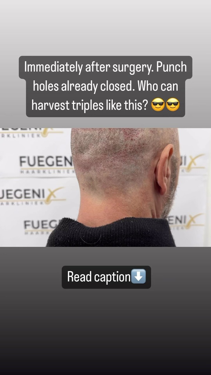 Anúncio de FueGenix Haarkliniek