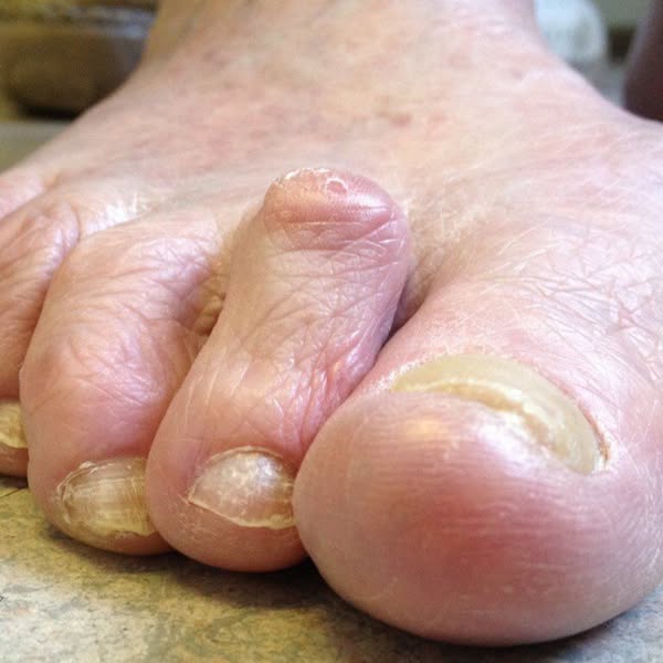 Hammertoe Treatment