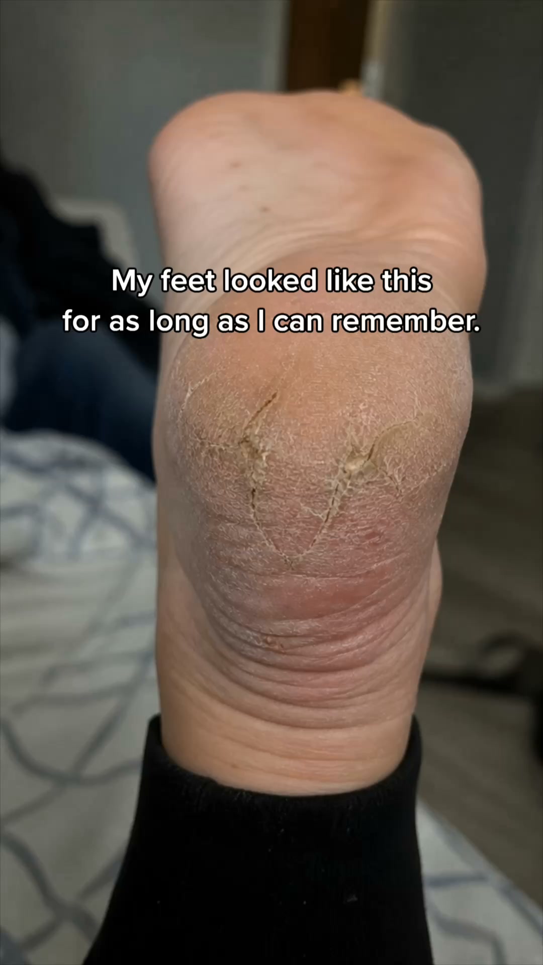 Smooth feet. In minutes. Guaranteed.