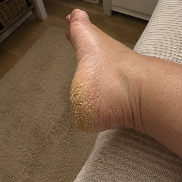 Lis ça si tes talons fissurent toujours