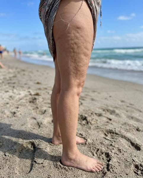 my cellulite is finally GONE