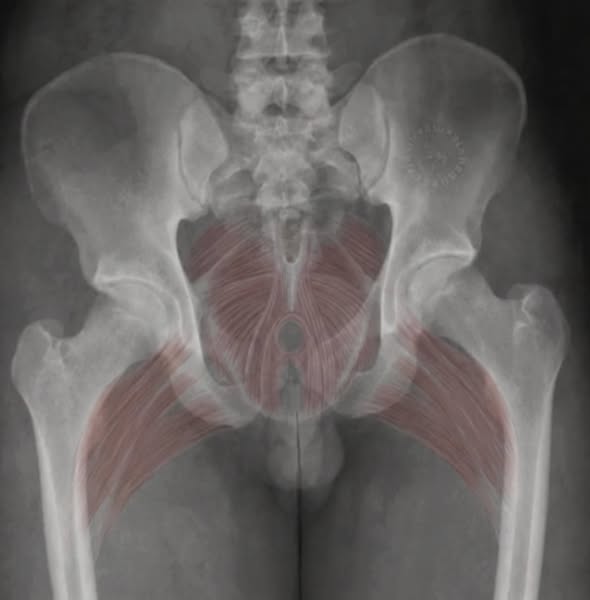 When Kegels Haven’t Been Enough