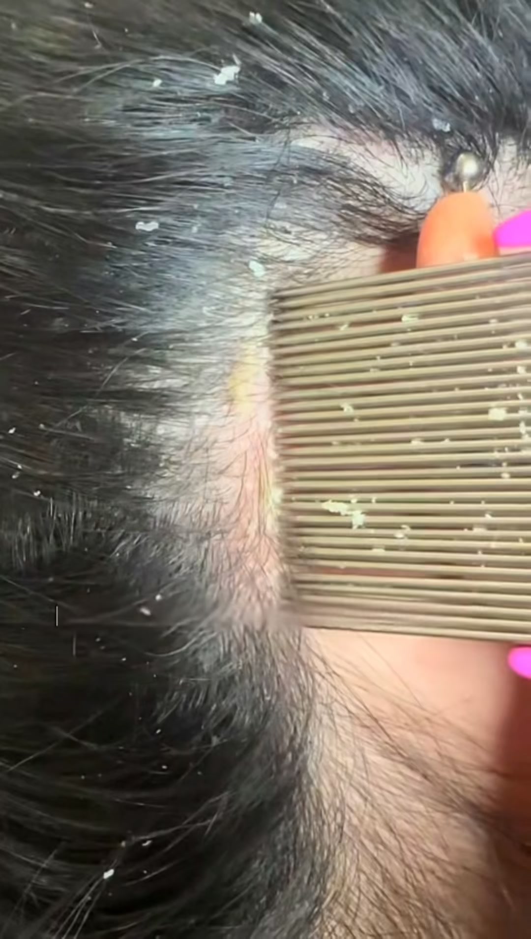 It’s Not Just A Dry Scalp