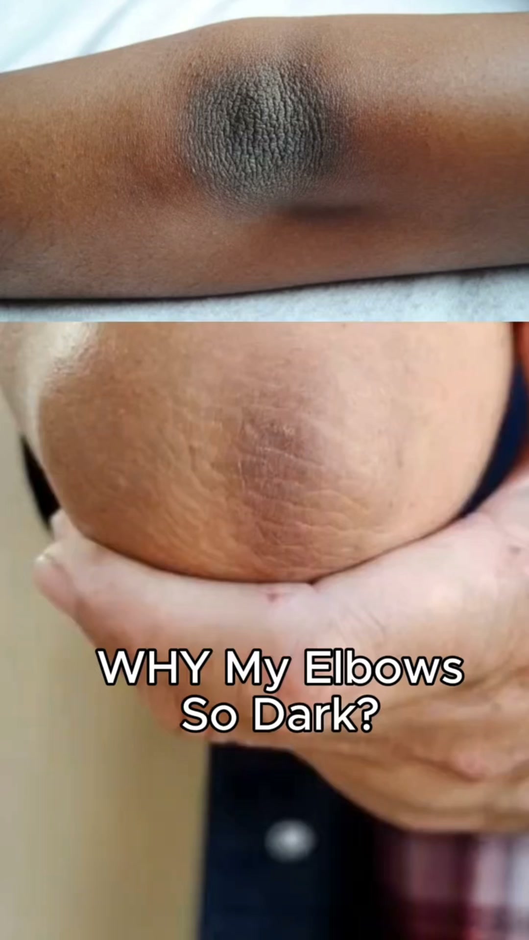 Stop Ignoring Your Elbows