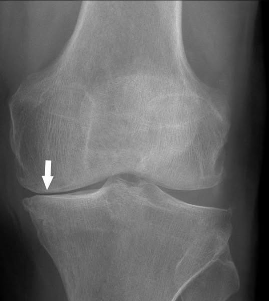 "12 years of knee pain gone in 2 days?"