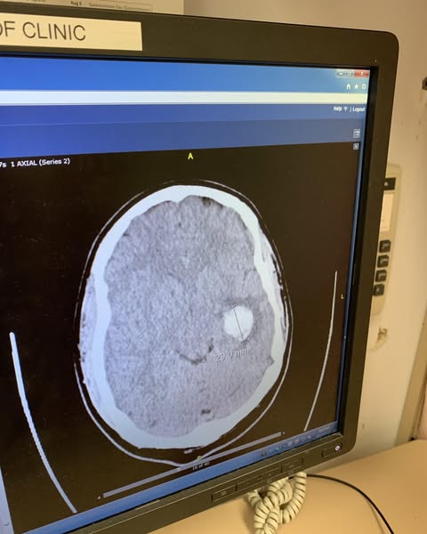 Why Most Stroke Survivors Stop Getting Better
