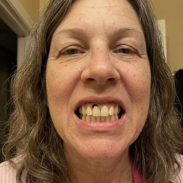 Read this if you have a damaged enamel...