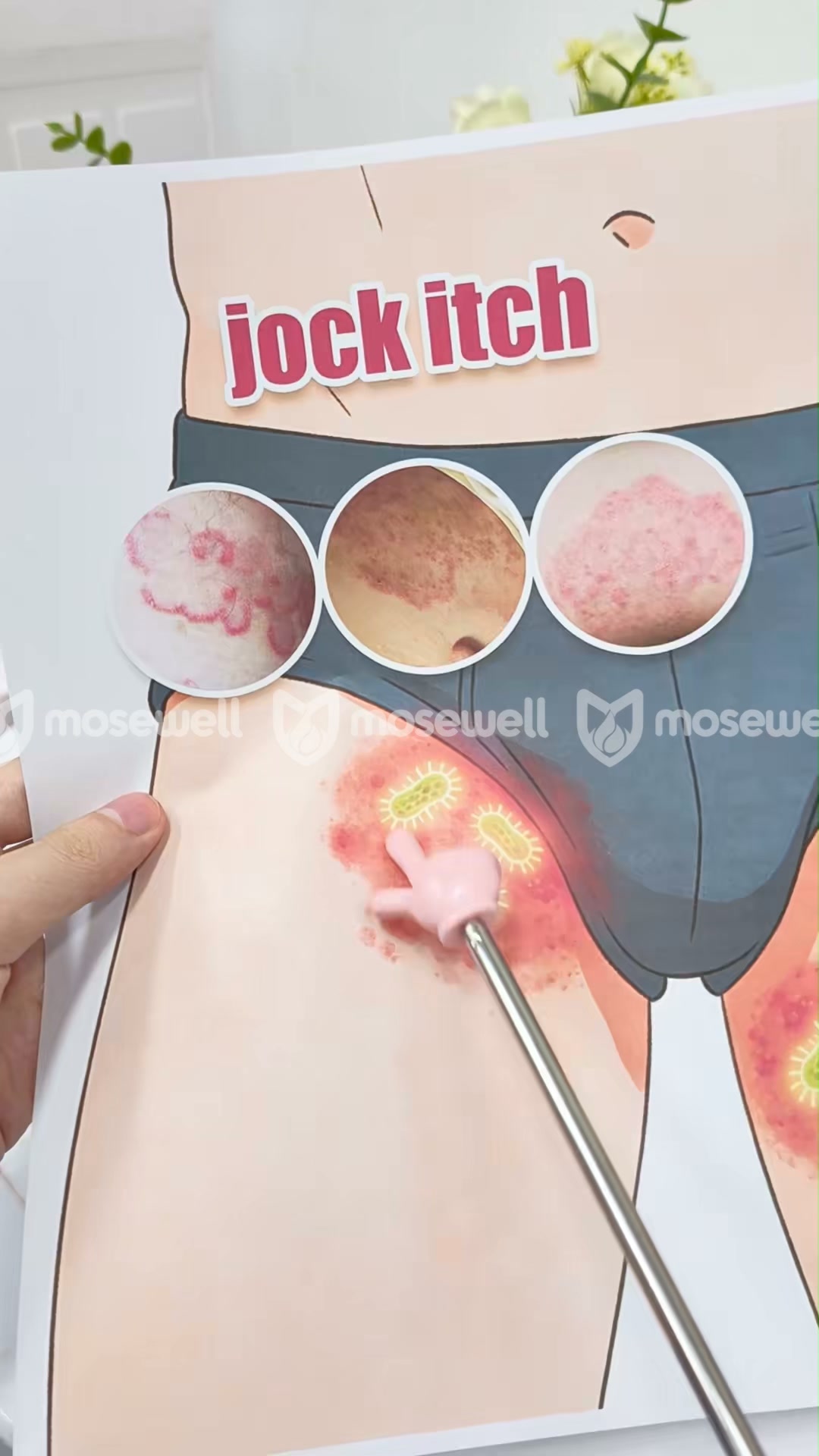 Jock Itch: Break the Itch–Scratch Cycle