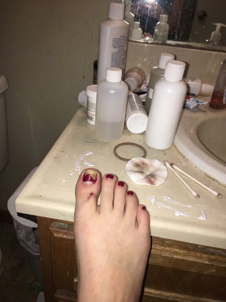 Read this if you have toe fungus