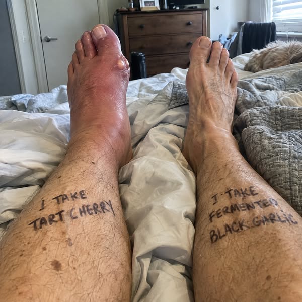 Nurse Gave The Same Gout Advice For 21 Years