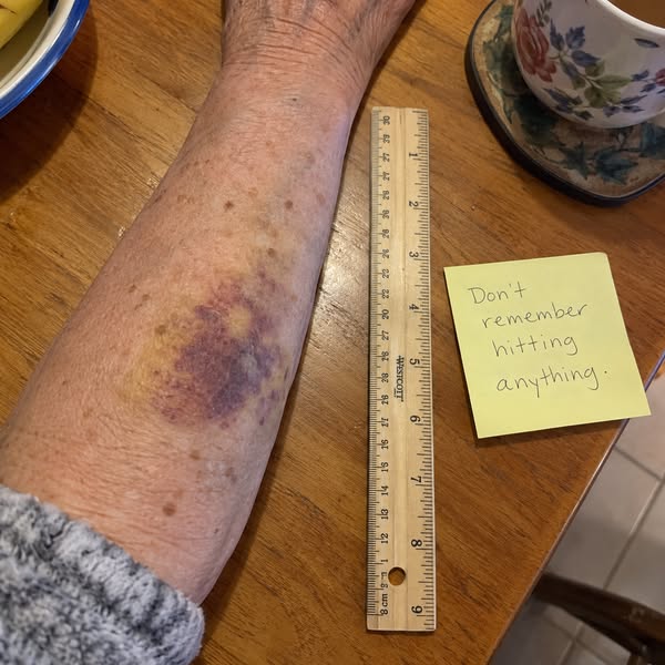 If your bruises keep coming back and nothing slows them down, read this