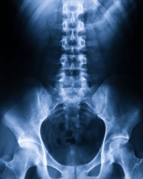 Spinal stenosis pain = their cash register
