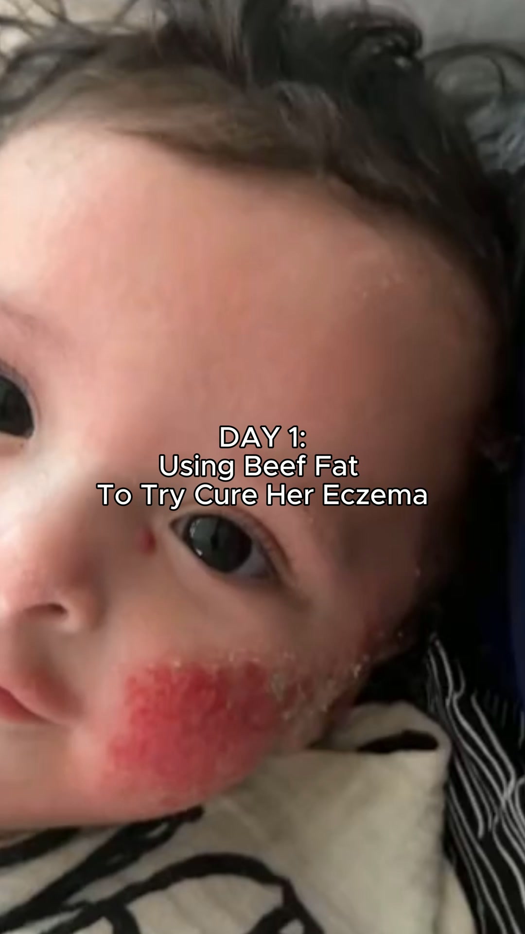 Clear Your Baby's Eczema in 30 Days — Or Your Money Back.
