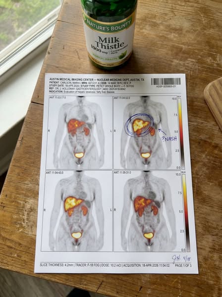 I Reversed My Fatty Liver In 9 weeks. And Milk Thistle Did Nothing.