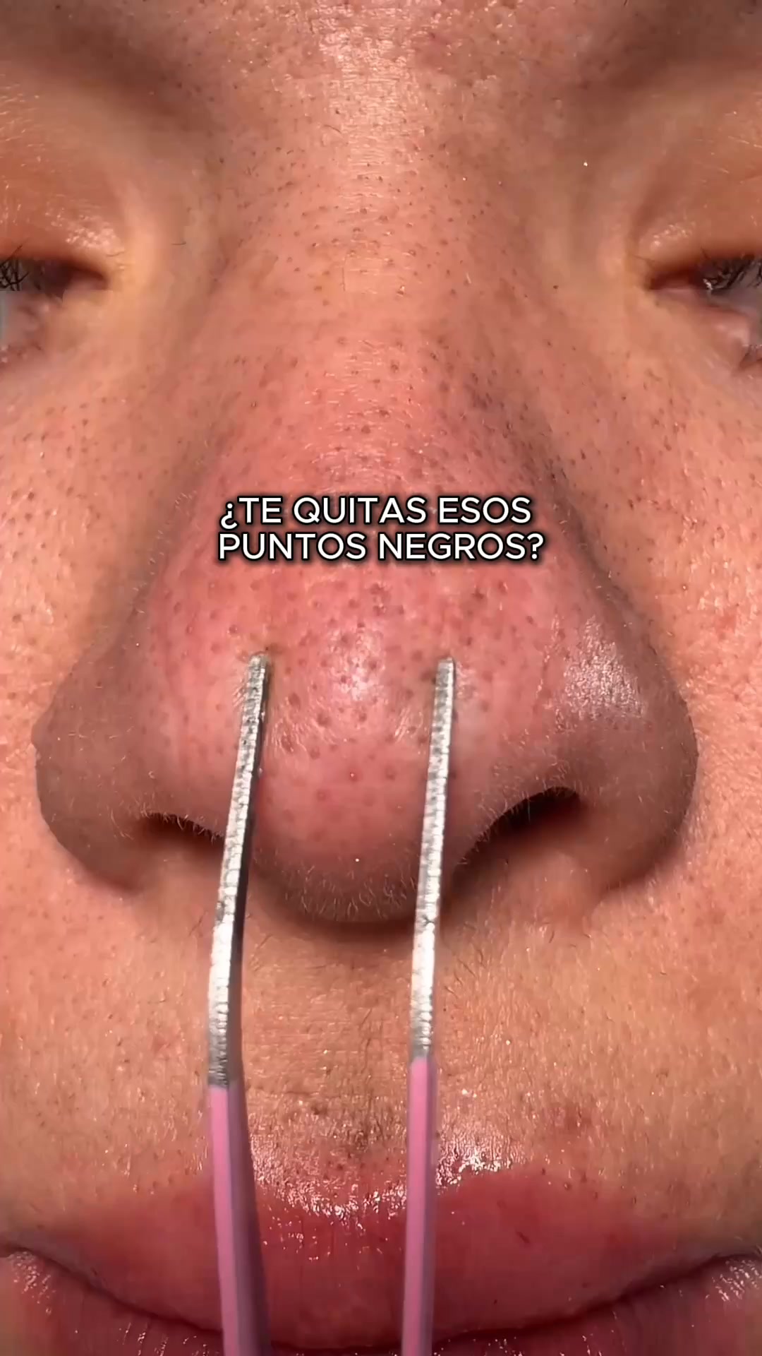 Adiós puntos negros - Sin tiras