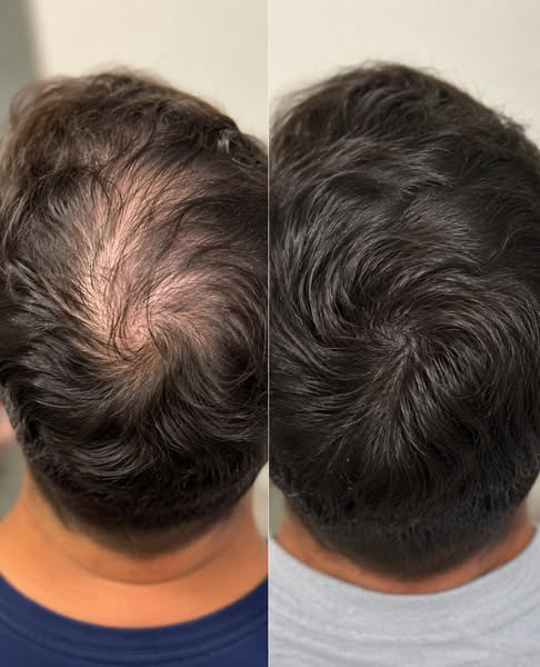 Bring back your hairline Naturally