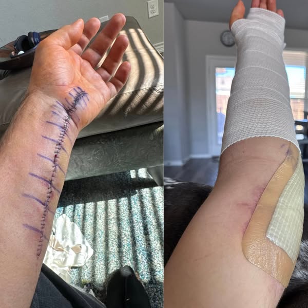 Carpal Tunnel Isn't Your Wrist. It's the Clamp.