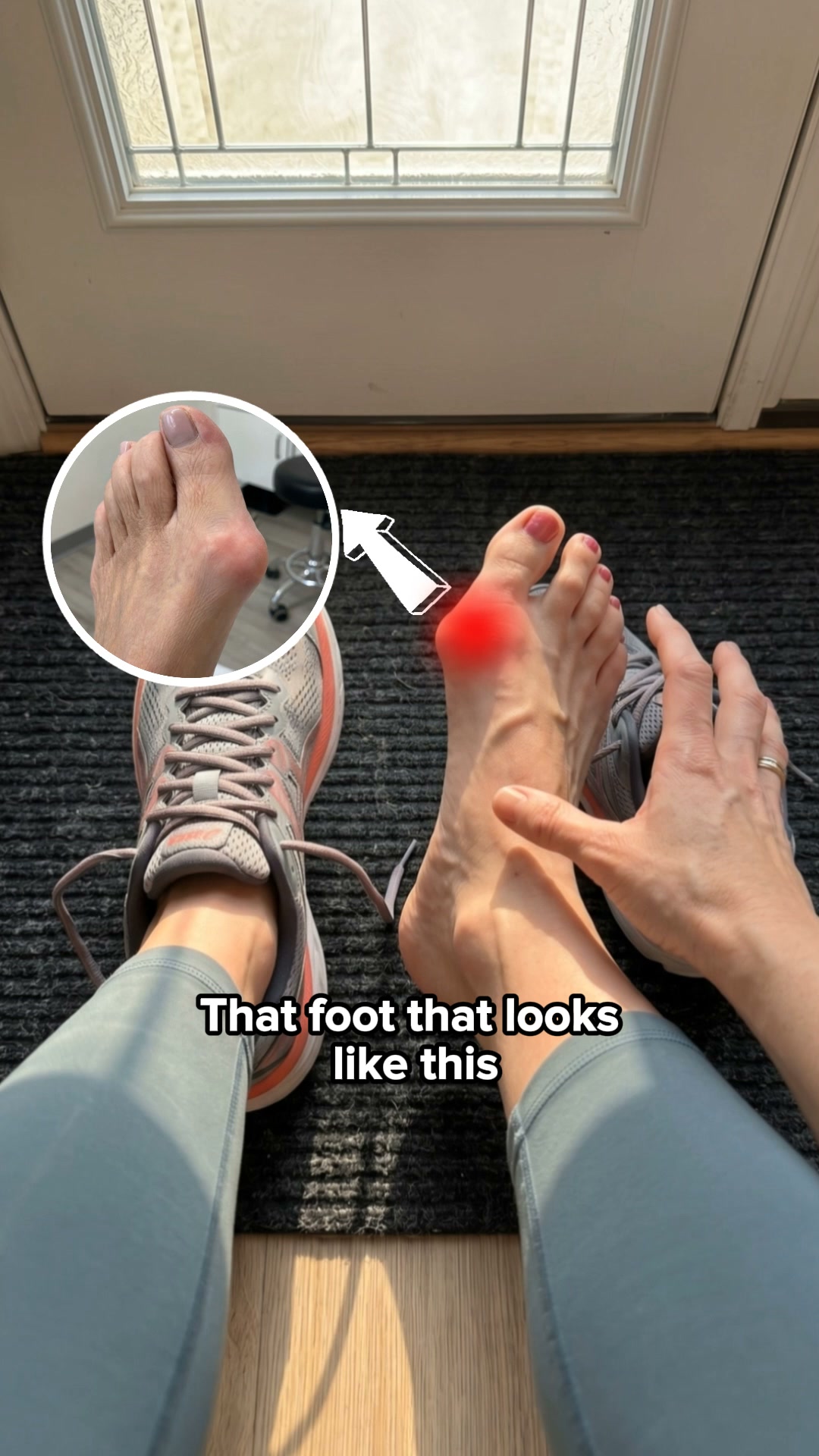 Fix Your Bunions Without Surgery