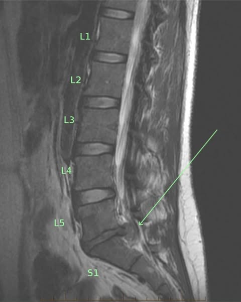 #1 relief for sciatic nerve pain?
