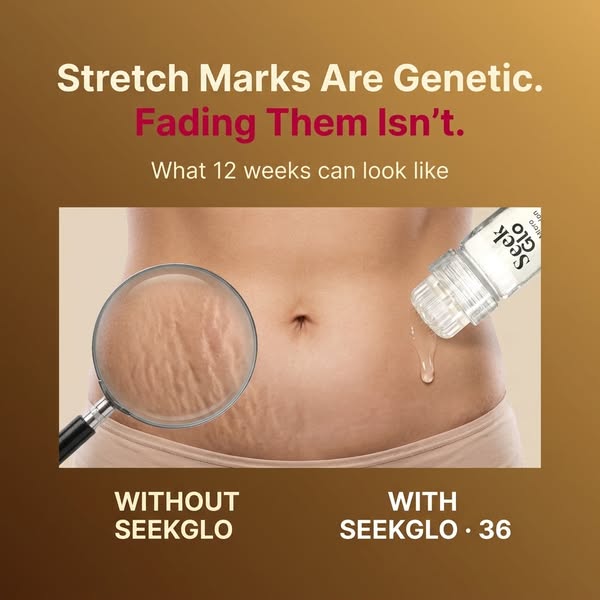 Stretch Marks? Try This At Home