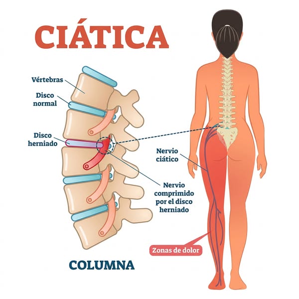 Esto es lo que nadie te ha contado sobre tu ciática.