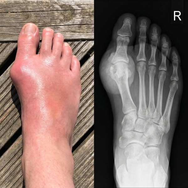 Allopurinol can help stop new uric acid being made — but it does nothing for the crystals already lodged in your joints.