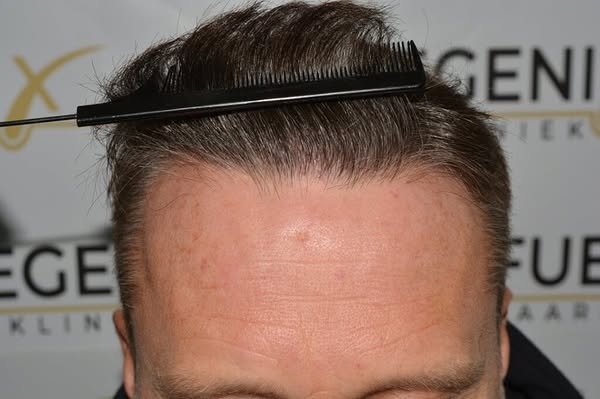 Art Gallery | FueGenix | Hair Restoration Artistry