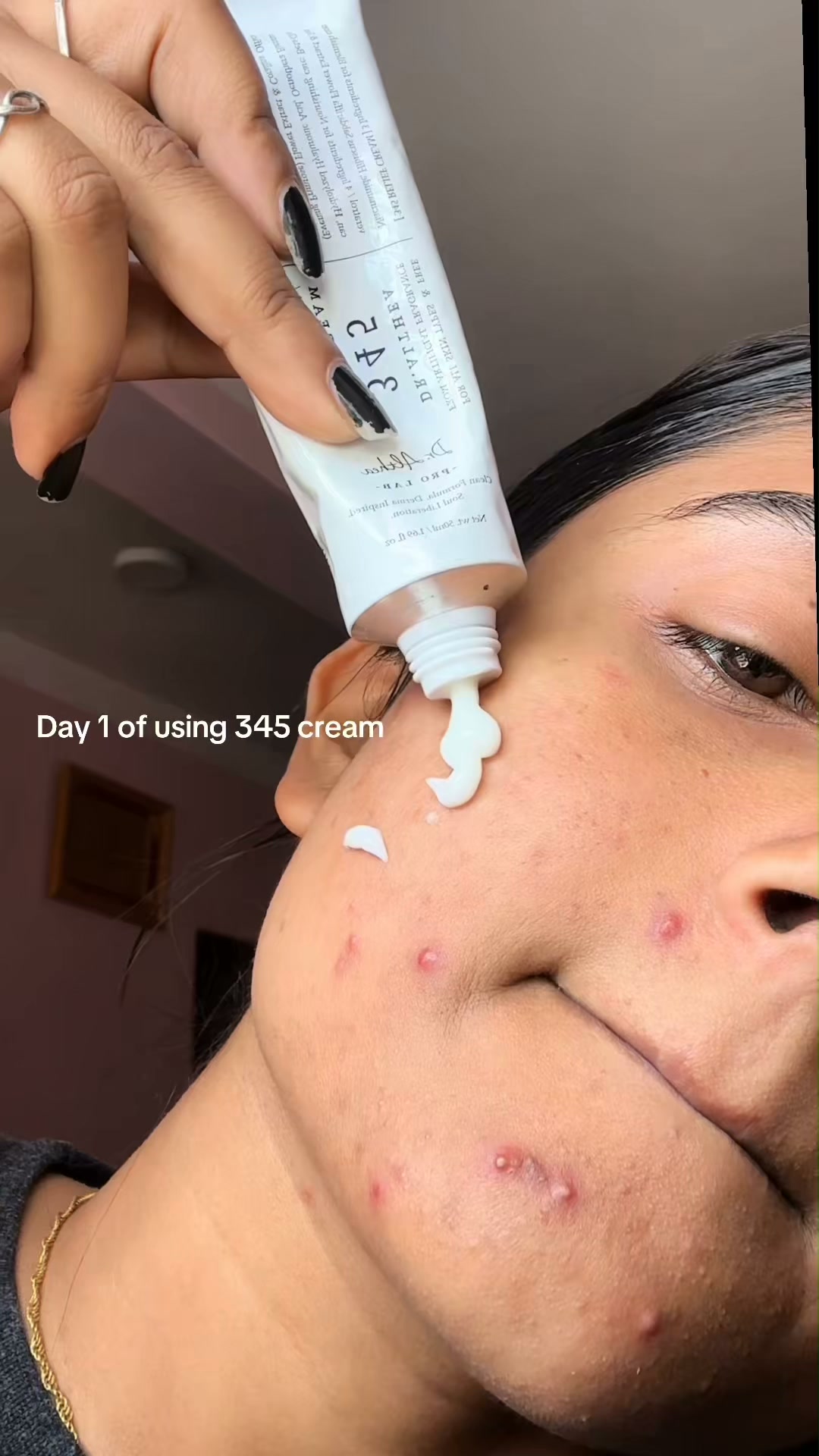 The Korean Answer To Acne’s Aftermath