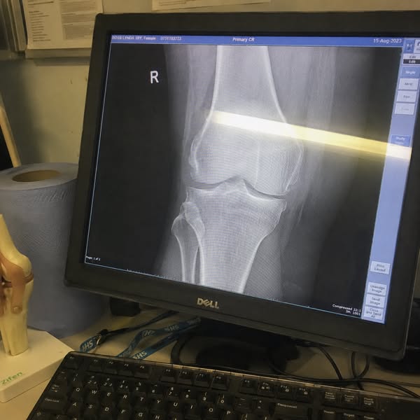 It's Not Bone-On-Bone. It's the Muscle Crushing the Joint