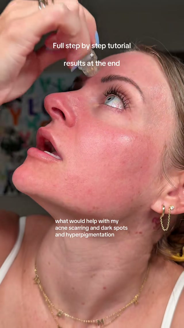 Hesitant To Start Micro-Infusion? Here’s what you need to know