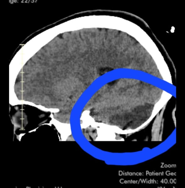 Why Most Stroke Survivors Stop Getting Better