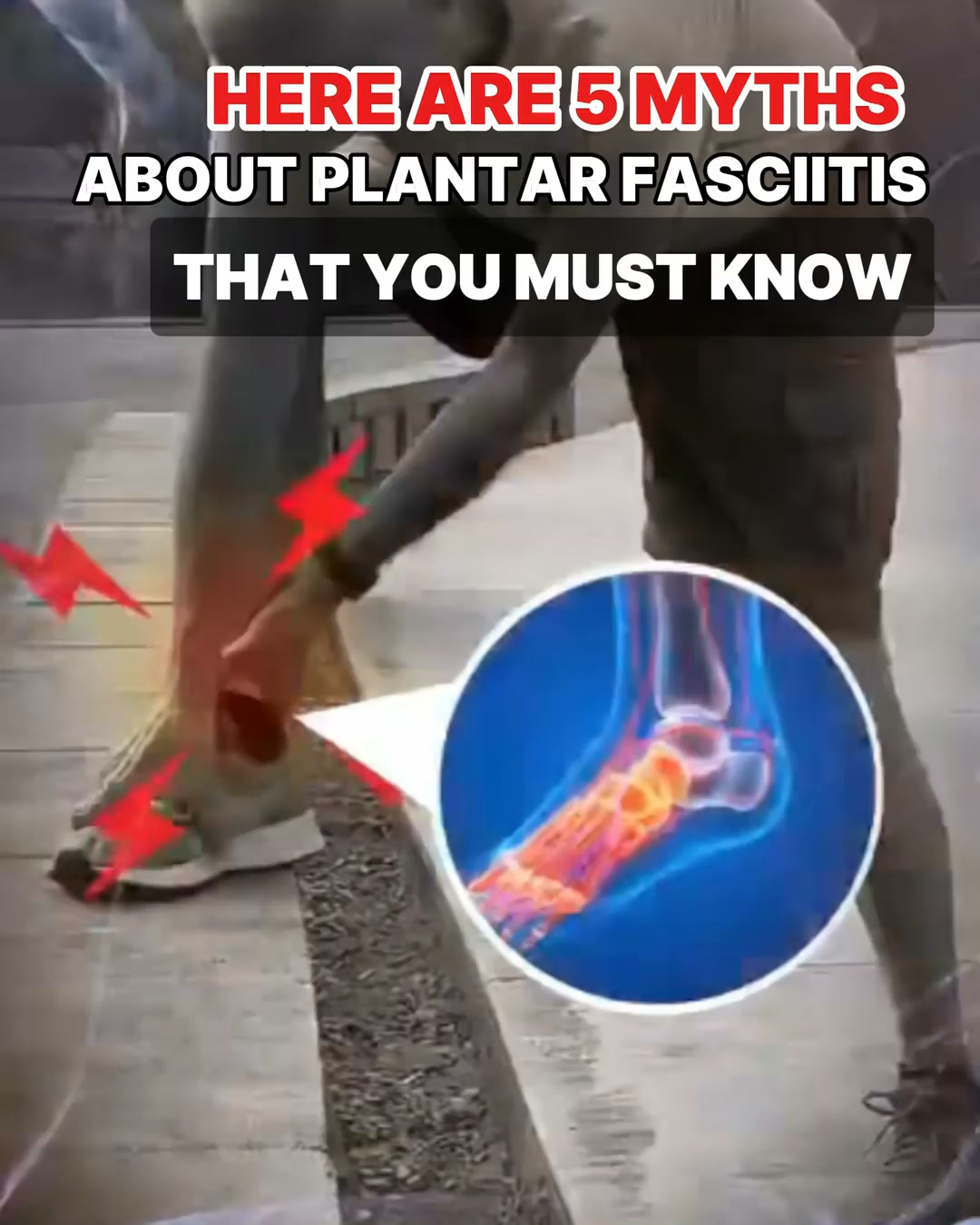 5 Plantar Fasciitis Myths