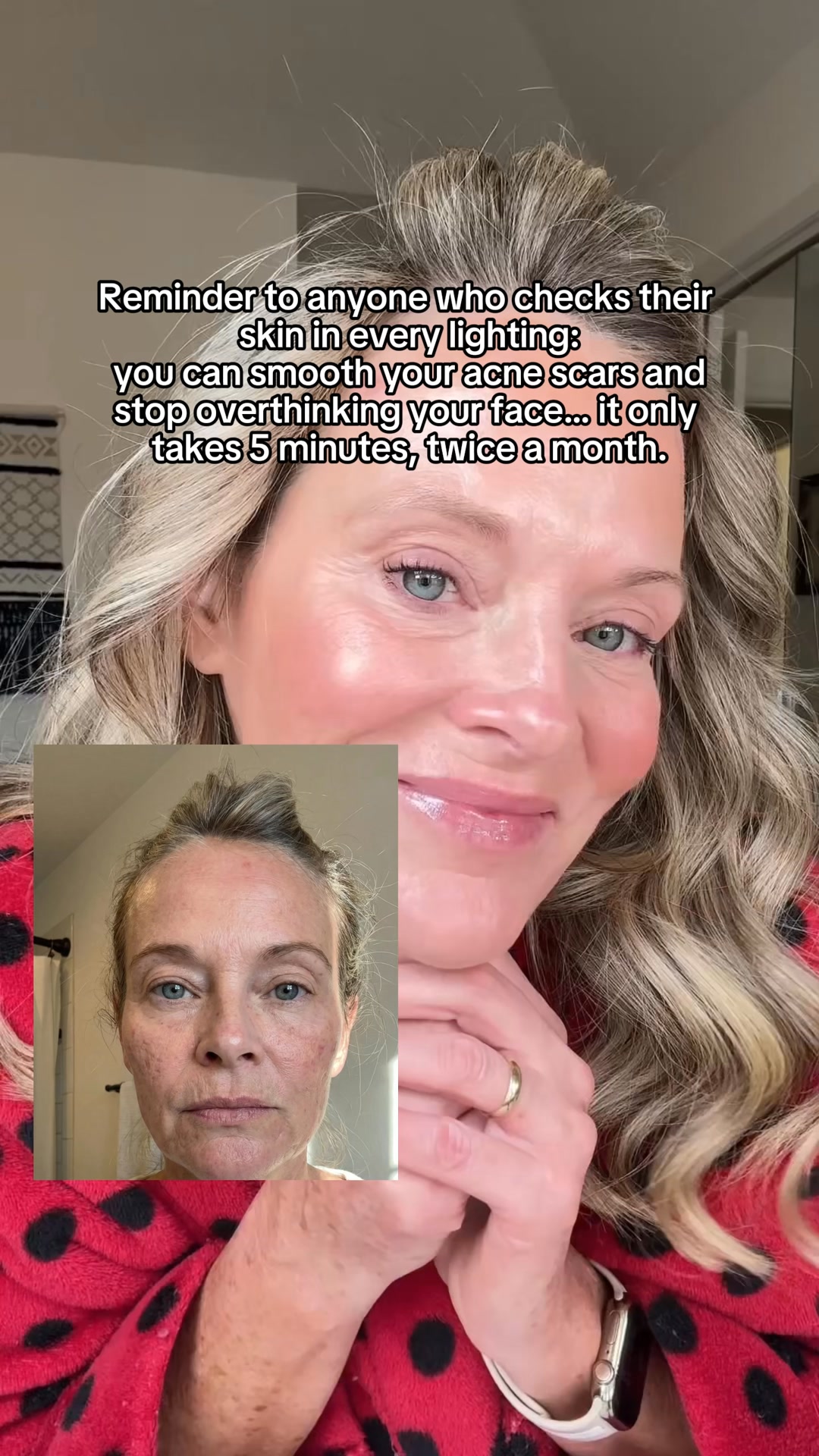 The DNA Repair Hack for Acne Scars
