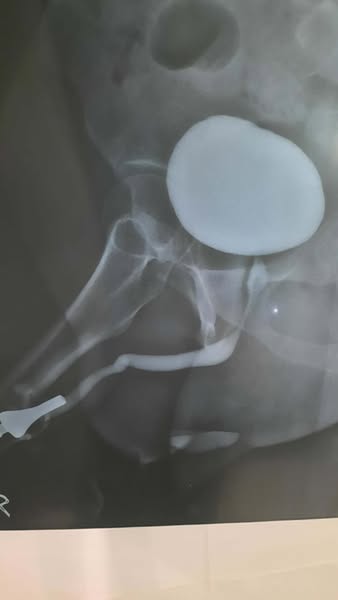 Nobody told me an enlarged prostate could do this.