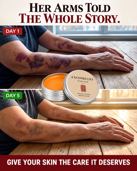Senile Purpura Gone In Days