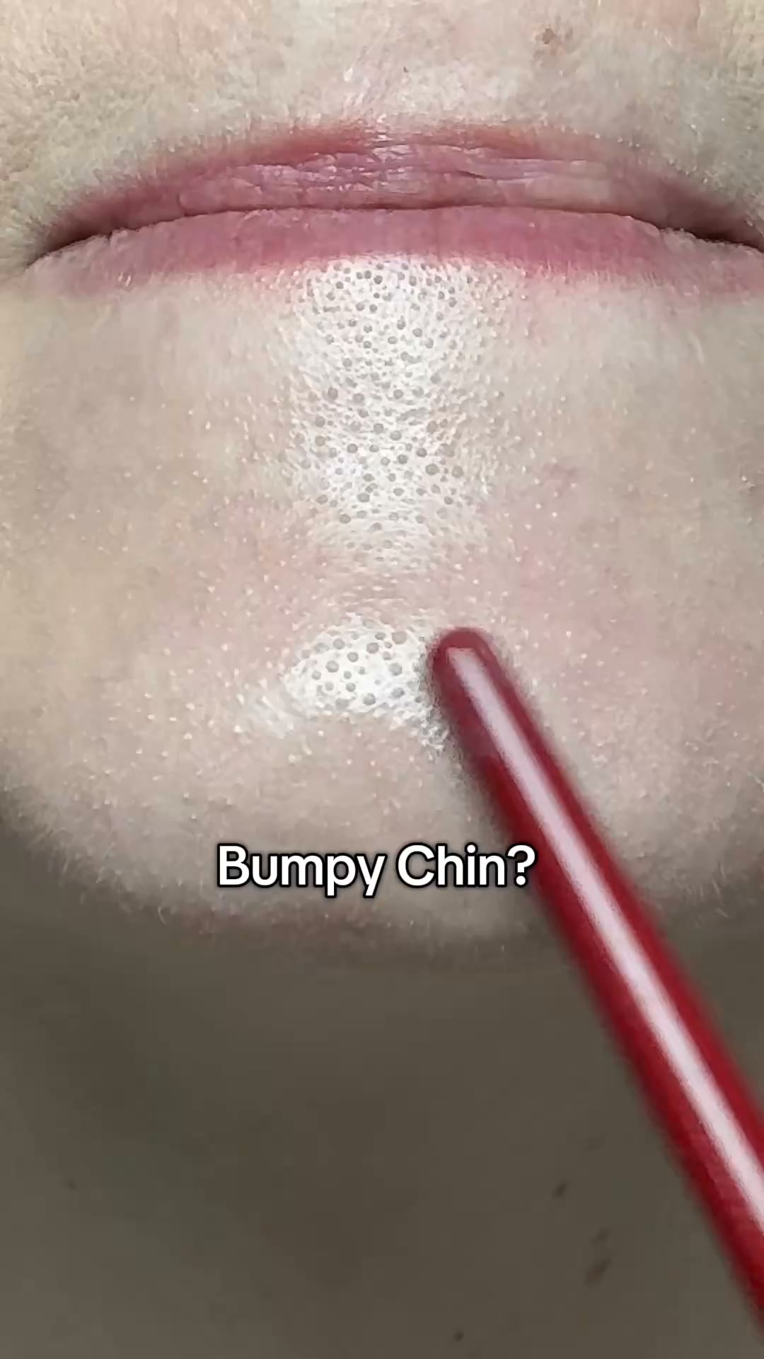 Say goodbye to blackheads