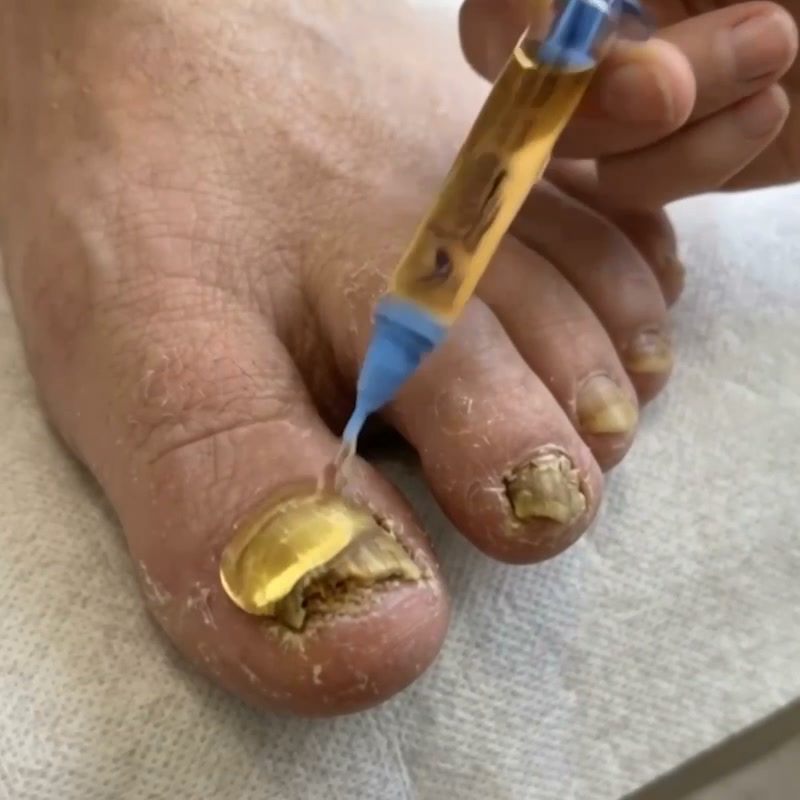 Stop Waiting for a GP | Clear Fungal Nails at Home