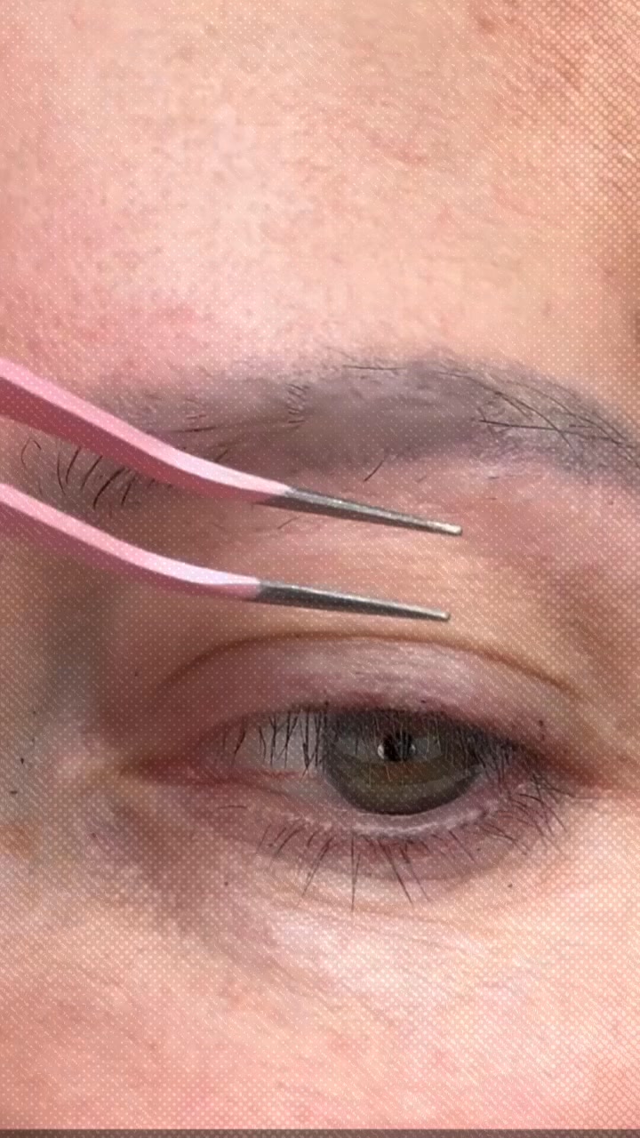 Donnez à vos paupières une chance avant la chirurgie