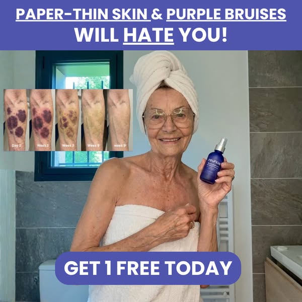Bruises Gone In Days!