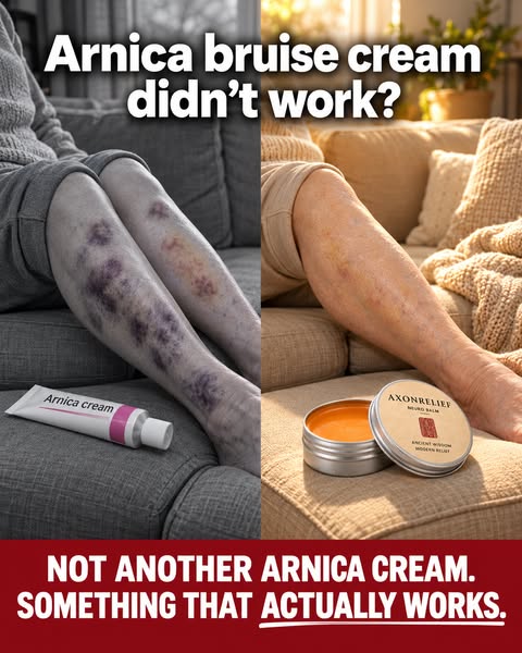 Senile Purpura Gone In Days