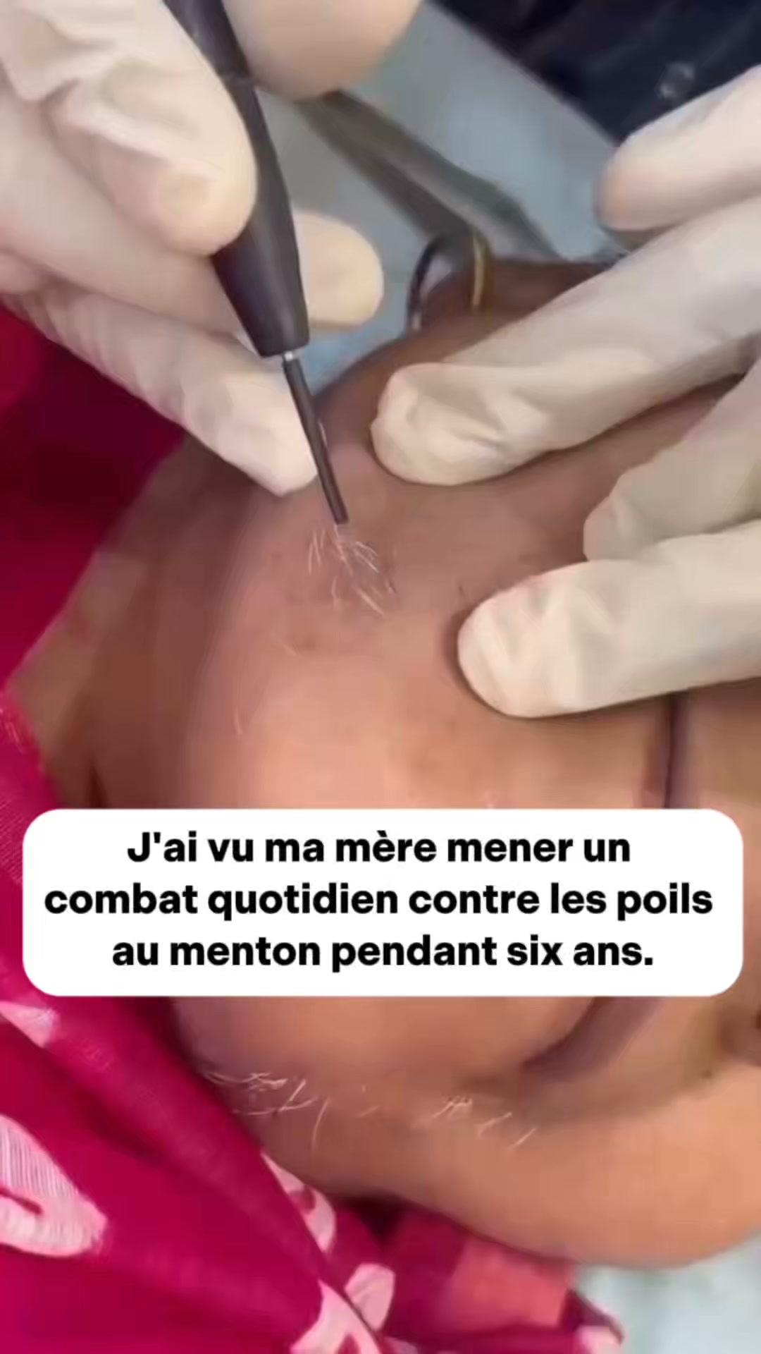 Empêchez vos poils du menton de repousser.